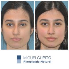 Rinoplastia - Dr. Miguel Ángel Cupito