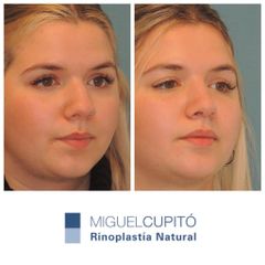 Rinoplastia - Dr. Miguel Ángel Cupito