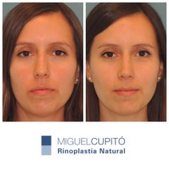 Rinoplastia - Dr. Miguel Ángel Cupito