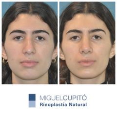 Rinoplastia - Dr. Miguel Ángel Cupito