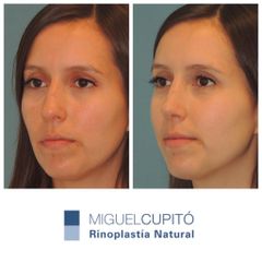 Rinoplastia - Dr. Miguel Ángel Cupito