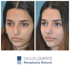 Rinoplastia - Dr. Miguel Ángel Cupito