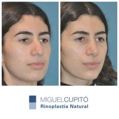 Rinoplastia - Dr. Miguel Ángel Cupito