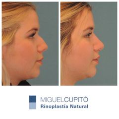 Rinoplastia - Dr. Miguel Ángel Cupito