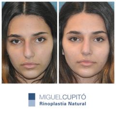 Rinoplastia - Dr. Miguel Ángel Cupito