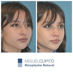 Rinoplastia - Dr. Miguel Ángel Cupito