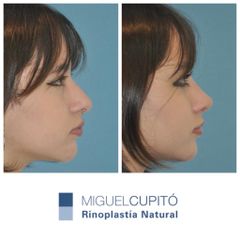 Rinoplastia - Dr. Miguel Ángel Cupito