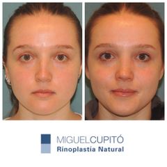 Rinoplastia - Dr. Miguel Ángel Cupito