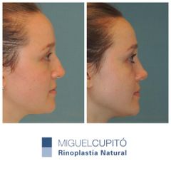 Rinoplastia - Dr. Miguel Ángel Cupito