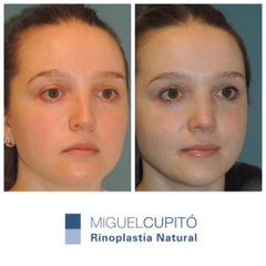 Rinoplastia - Dr. Miguel Ángel Cupito