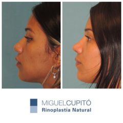 Rinoplastia - Dr. Miguel Ángel Cupito