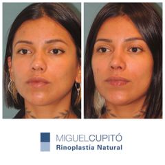 Rinoplastia - Dr. Miguel Ángel Cupito