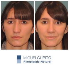 Rinoplastia - Dr. Miguel Ángel Cupito