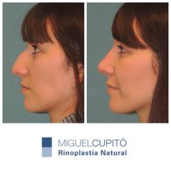 Rinoplastia - Dr. Miguel Ángel Cupito