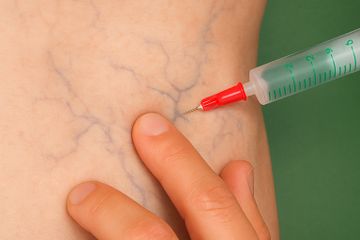 Flebología - Dr. Prof. Patricio J. Nally