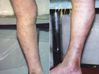 Flebología antes y después - 876940