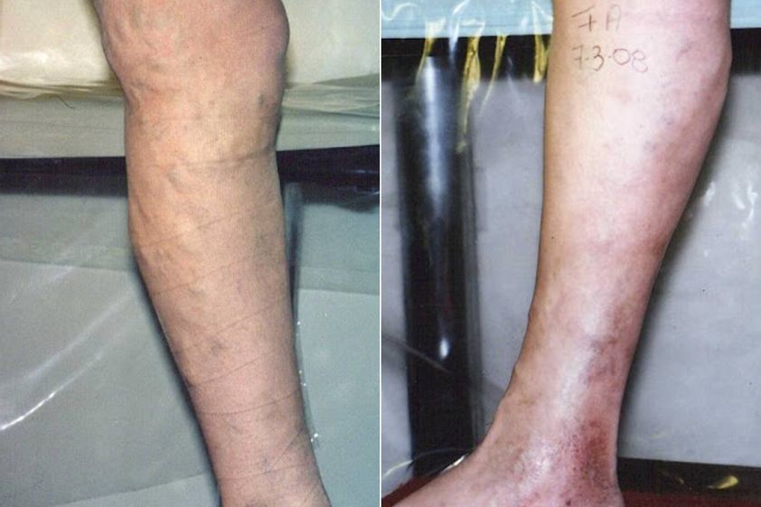 Flebología antes y después - 876940