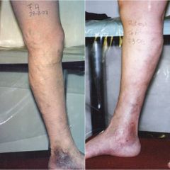 Flebología - Dr. Prof. Patricio J. Nally