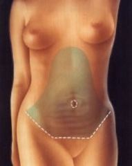 Abdominoplastia