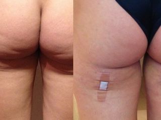 LIPOESCULTURA SUPERFICIAL 
