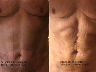 Lipoaspiración con marcación abdominal