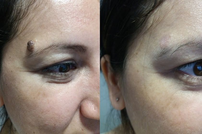 Lunares antes y después - 633093