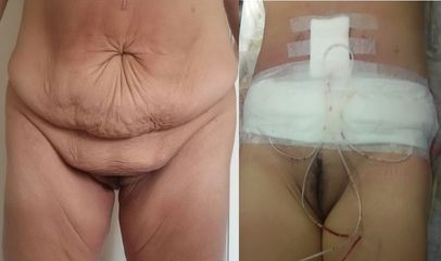 Dermolipectomía - Dra. Adriana Ratto