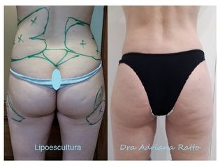 Lipoescultura - Dra. Adriana Ratto