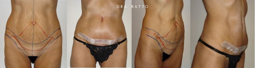 Dermolipectomia - Dra. Adriana Ratto