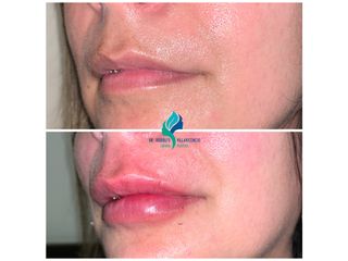 Relleno de labios con ácido hialuronico