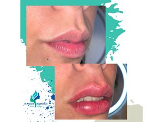 Relleno de labios con ácido hialuronico - Dr. Rodolfo Villavicencio