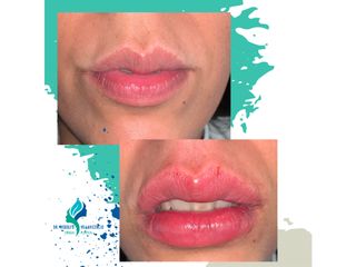 Relleno de labios con Ácido Hialuronico - Dr. Rodolfo Villavicencio