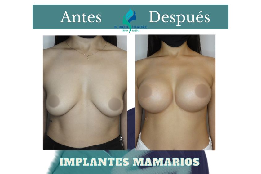 Mastopexia antes y después - 824568