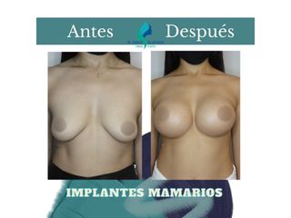 Mastopexia periareolar con implantes mamarios 375 cc