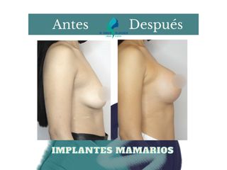Mastopexia periareolar con implantes mamarios 375 cc