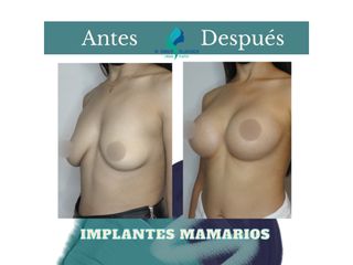 Mastopexia periareolar con implantes mamarios 375 cc