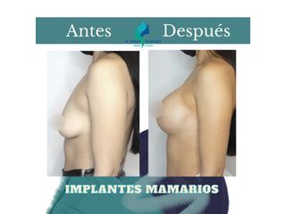 Mastopexia periareolar con implantes mamarios 375 cc