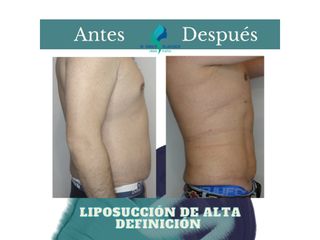 Liposuccion de Alta Definición