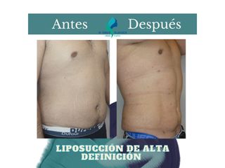 Liposuccion de Alta Definición
