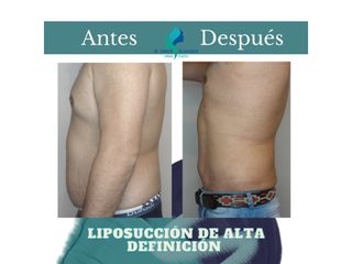 Liposuccion de Alta Definición