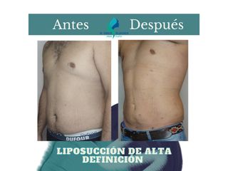Liposuccion de Alta Definición