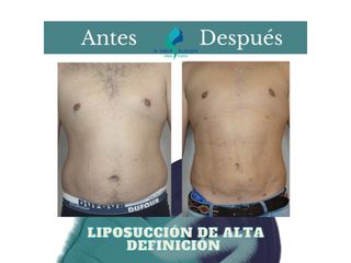Liposuccion de Alta Definición