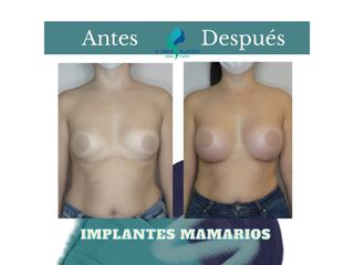 Pre y Postoperatorio de 2 meses de implantes Mamarios 350cc retromuscular