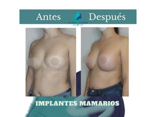Pre y Postoperatorio de 2 meses de implantes Mamarios 350cc retromuscular