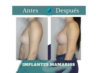 Pre y Postoperatorio de 2 meses de implantes Mamarios 350cc retromuscular