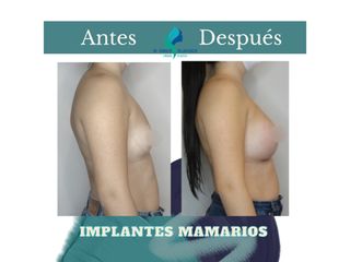 Pre y Postoperatorio de 2 meses de implantes Mamarios 350cc retromuscular