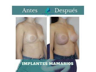 Pre y Postoperatorio de 2 meses de implantes Mamarios 350cc retromuscular