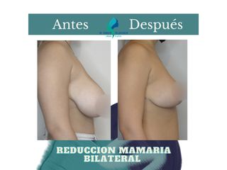 Pre y Postoperatorio de 6 meses de Reducción mamaria