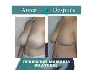 Pre y Postoperatorio de 6 meses de Reducción mamaria