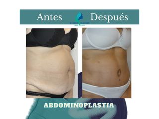 Abdominoplastia - Dr. Rodolfo Villavicencio